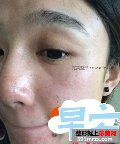 激光去斑效果如何 激光祛斑前后对比图