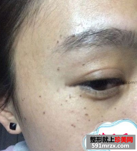 激光去斑效果如何 激光祛斑前后对比图