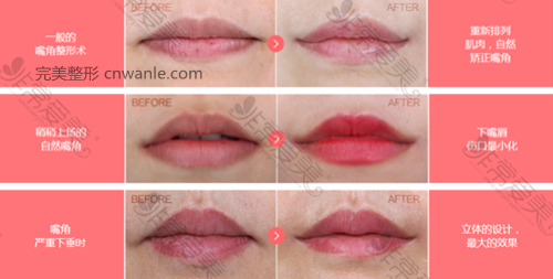 韩国女神医院嘴角<a href='/tag_zhengxinganli.html'>整形案例</a> 韩国女神医院嘴角整形案例