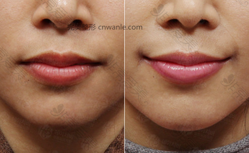 韩国HB整形外科嘴角上扬手术案例 韩国HB整形外科嘴角上扬手术案例