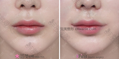 韩国初见医院嘴角上扬案例 韩国初见医院嘴角上扬案例