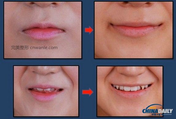 近几个月来，一种被称为“Smile Lipt”的嘴角<a href='/tag_zhengrong3.html'>整容</a>手术在韩国非常风靡。该手术将嘴角切开再缝合，重新调整上下颚的角度，使得嘴部的线条更柔和。