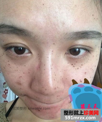 激光去斑效果如何 激光祛斑前后对比图