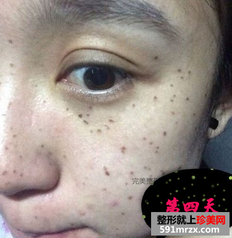 激光去斑效果如何 激光祛斑前后对比图