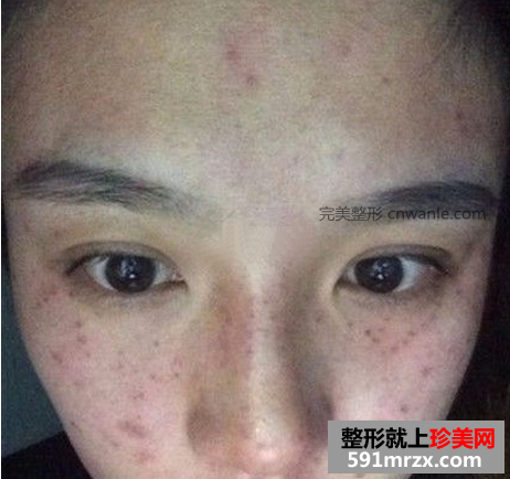 激光去斑效果如何 激光祛斑前后对比图