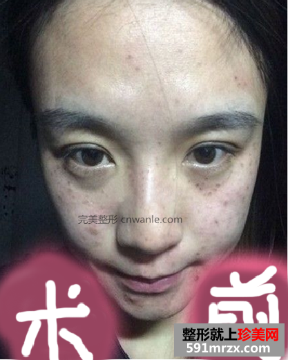 <a href='/tag_jiguangquban52.html'>激光去斑</a>效果如何 激光祛斑<a href='/tag_qianhouduibi.html'>前后对比</a>图