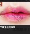 嘴角上扬手术