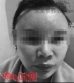 女子花39万打美容针中毒 术后面部僵硬嘴角歪