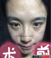 激光去斑效果如何 激光祛斑前后对比图