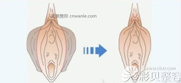 阴唇缩小效果对比图