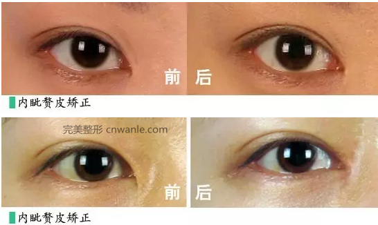 内眦赘皮