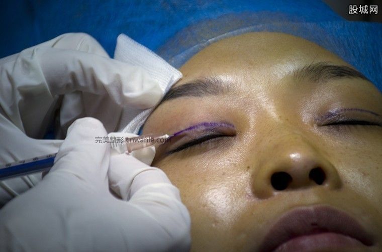 开眼角手术多少钱