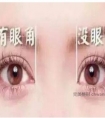 开眼角的好处是什么呢 开眼角需要注意什么呢