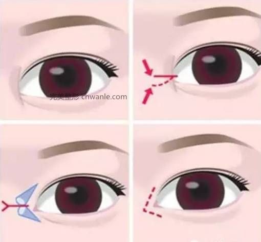怎么判断需不需要开眼角？