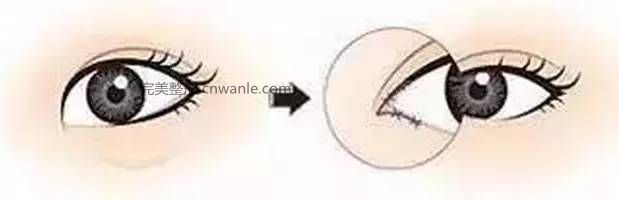 怎么判断需不需要开眼角？