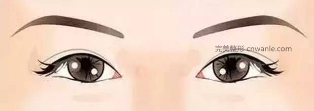 怎么判断需不需要开眼角？