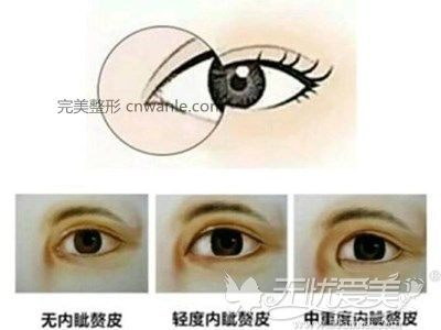 内眦赘皮分级对比图