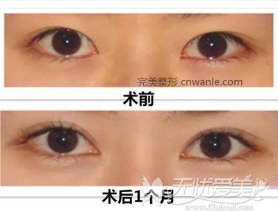 内眦赘皮矫正手术1个月的对比图