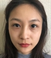 分享我做电波拉皮的经历、电波拉皮除皱的效果看好了啊!