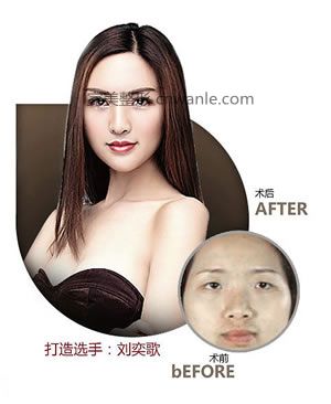 昆明美莱开眼角会让眼睛变大吗？