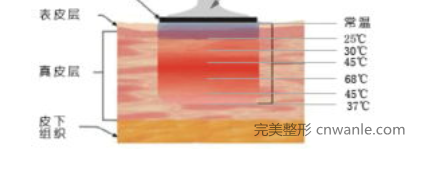 什么是PRT电波拉皮，电波拉皮多少钱一次？