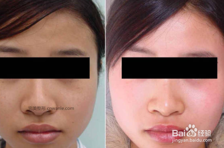 什么是PRT电波拉皮,电波拉皮多少钱一次?