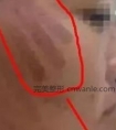 超皮秒的危害大吗、皮秒激光祛斑的后遗症太吓人了!