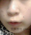 今天是做激光去痣一周了,大家帮着看看效果怎么样喔