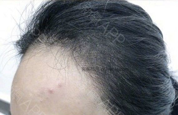 半永久纹发际线