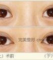 开眼角的六大好处,您知道了吗?