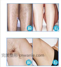 脱毛<a href='/tag_qianhouduibi.html'>前后对比</a>照