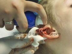 耳畸形矫正术适应症