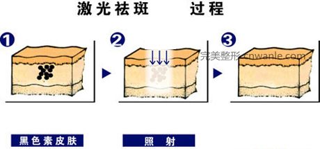 激光祛斑.jpg