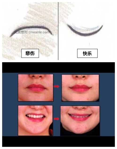 微笑也可定格 韩国流行“嘴角上扬”手术