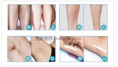 广州冰点脱毛有哪些优势?