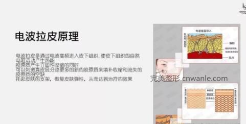 电波拉皮？是个什么鬼