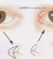 为什么我开了眼角,反而变丑了?