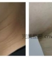电波拉皮除皱效果好不好