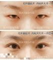 【准备开眼角的必看】开眼角必犯误区!以及开眼角须知的所有问题