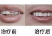 口角成形术有没有副作用?