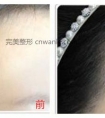 半永久发际线适应人群