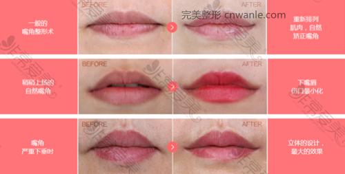 韩国女神医院嘴角<a href='/tag_zhengxinganli.html'>整形案例</a> 韩国女神医院嘴角整形案例