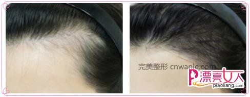 半永久纹发际线和发际线种植哪一种好？