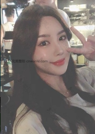 韩国HB医院唇部整形效果 韩国HB医院唇部整形效果