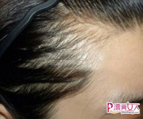 半永久纹发际线和发际线种植哪一种好?