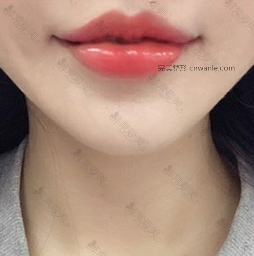 HB整形医院唇部整形效果 HB整形医院唇部整形效果