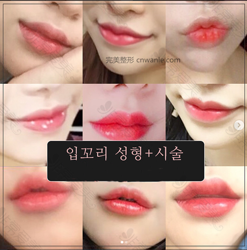 韩国HB医院官网唇部整形案例 韩国HB医院官网唇部整形案例