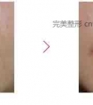 嘴角上扬整容手术需要多少钱?