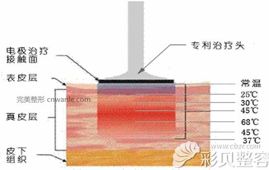 电波拉皮除皱作用原理