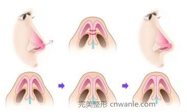 鼻尖整形方法的有哪些